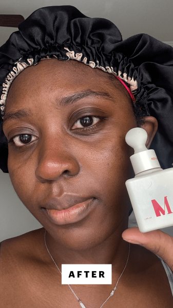 BlayTettey after applying the  Dr. Diamonds Metacine Instafacial Plasma